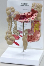 Colon With Pathology Pharmaceutical and Anatomical Model Gifts 